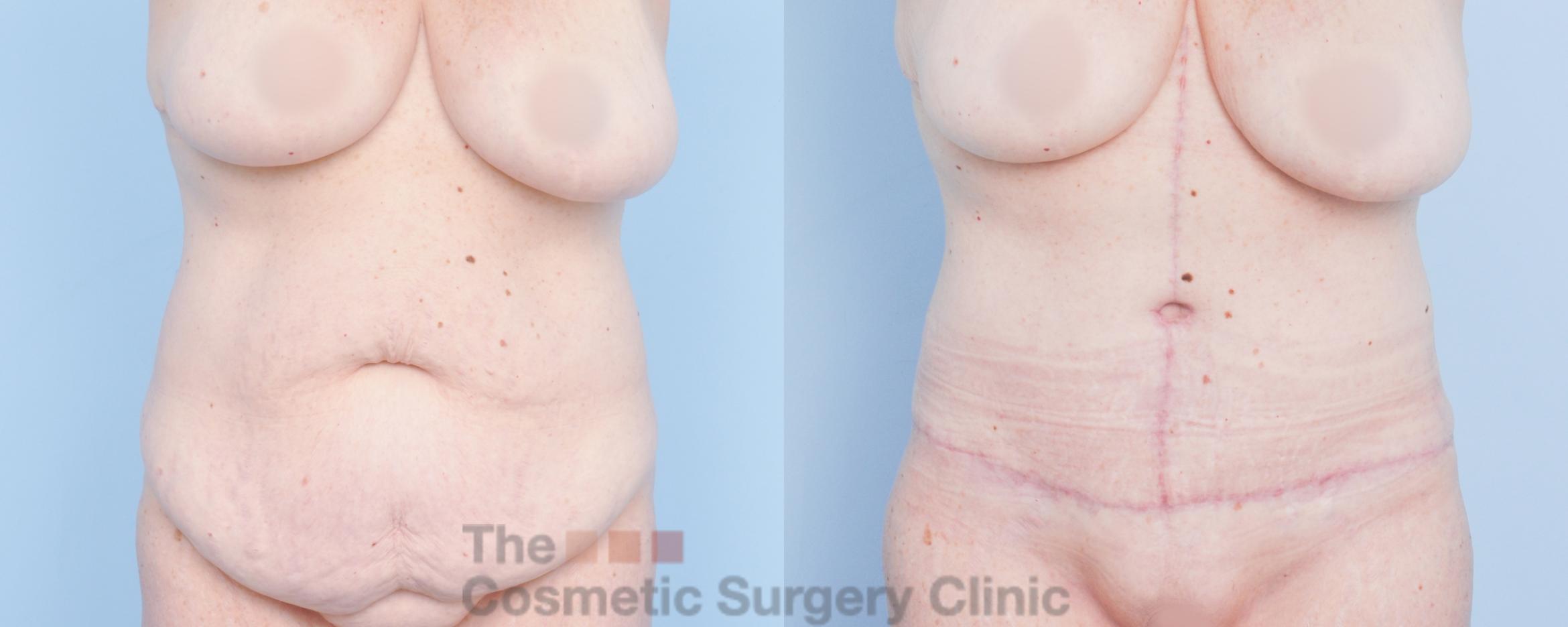 Before & After Tummy Tuck Case 918 Front View in Waterloo, Ontario