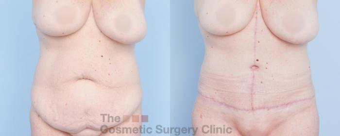 Before & After Tummy Tuck Case 918 Front View in Waterloo, Ontario
