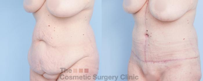 Before & After Tummy Tuck Case 918 Left Oblique View in Waterloo, Ontario