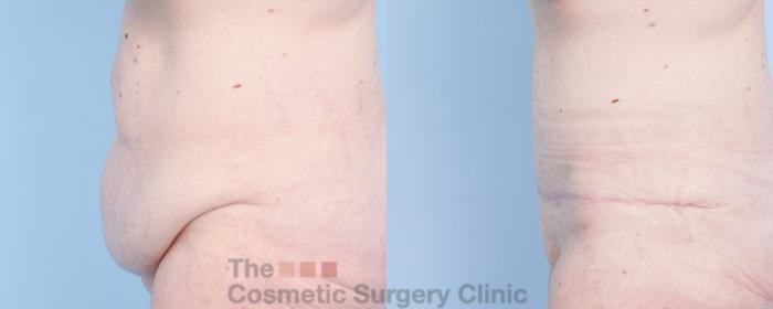 Before & After Tummy Tuck Case 918 Left Side View in Waterloo, Ontario