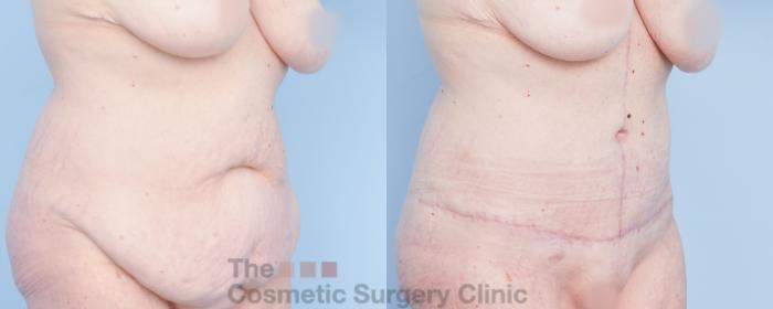 Before & After Tummy Tuck Case 918 Right Oblique View in Waterloo, Ontario