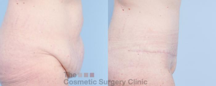 Before & After Tummy Tuck Case 918 Right Side View in Waterloo, Ontario